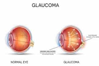 Glaucoma Management | Glaucoma Surgery in Pune